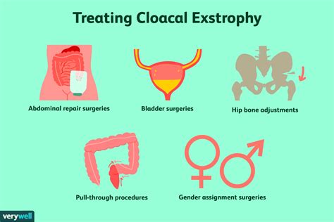 Cloacal Exstrophy: Symptoms, Causes, and Treatment