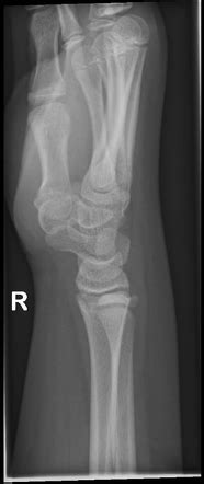 Pediatric wrist (lateral view) | Radiology Reference Article ...