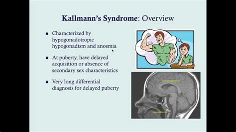 Kallmann's Syndrome - CRASH! USMLE Step 2 and 3 | Kallmann syndrome ...