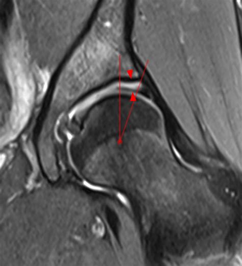 Developmental Dysplasia of the Hip - Radsource