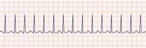 ECG INTERPRETATION FOR NCLEX: PART THREE - The Nurse Speak