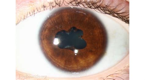 Ocular Synechiae: A Rare but Serious Eye Condition | OBN