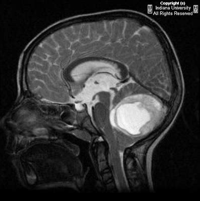 Neuroradiology On the Net: Pilocytic astrocytoma