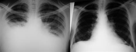 Resolution of pleural effusions after treatment for loiasis. Chest ...