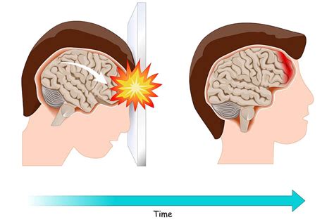 Traumatic Brain Injury No Symptoms - Ogborn Mihm, LLP