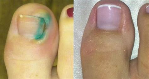 Here Is How You Can Pull Out The Ingrown Toenail Without Operation ...