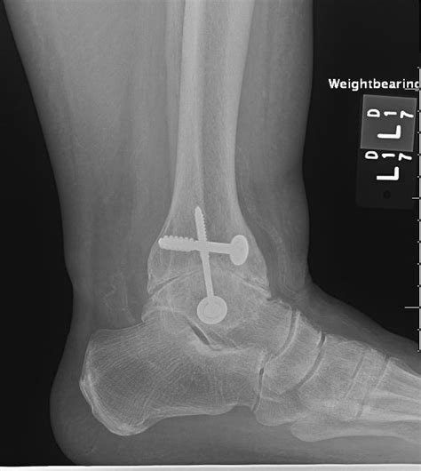 Ankle Arthrodesis - Foot & Ankle - Orthobullets