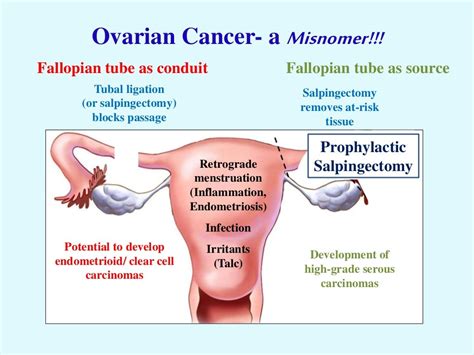 Prophylactic Salpingectomy