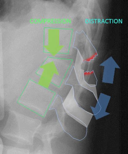 Chance Fracture (flexion-distraction injury) - Spine - Orthobullets