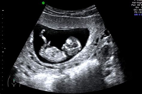 12-week pregnancy dating scan - NHS