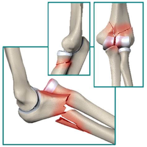 Elbow Fracture - Rehab On The Road