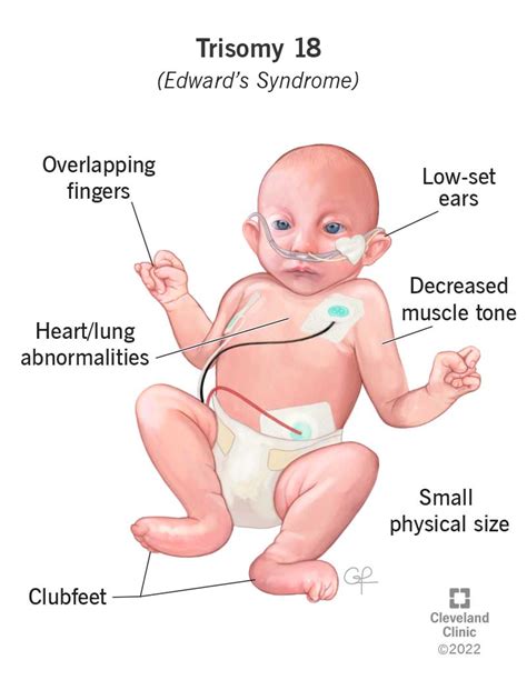 Edwards Syndrome (Trisomy 18): Genetic Condition, Symptoms & Outlook