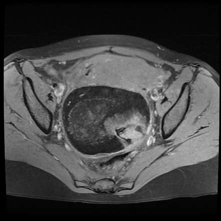 Right ovarian dermoid cyst in pregnancy (MRI) | Image | Radiopaedia.org