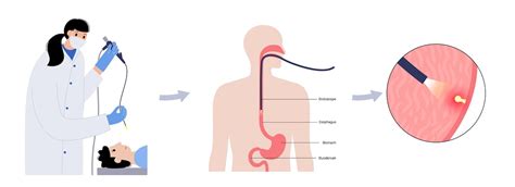 Premium Vector | Gastroscopy procedure stomach polyps diagnostic ...