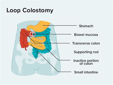 Loop Colostomy: What You Should Know