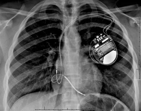 A New Study on Legacy Pacemakers & MRI Scanning