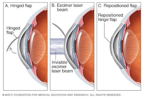 LASIK eye surgery - Mayo Clinic