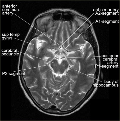 Anatomy Of Brain Ct Scan Anatomy Drawing Diagram | Images and Photos finder