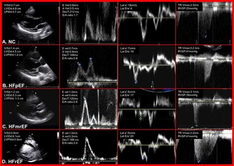 Echocardiogram Of Heart Failure