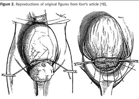 Figure 2 from The History of the Low Transverse Cesarean Section: The ...