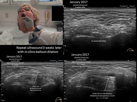 Parotid duct stricture sialoballon dilation with fluoroscopy and ...