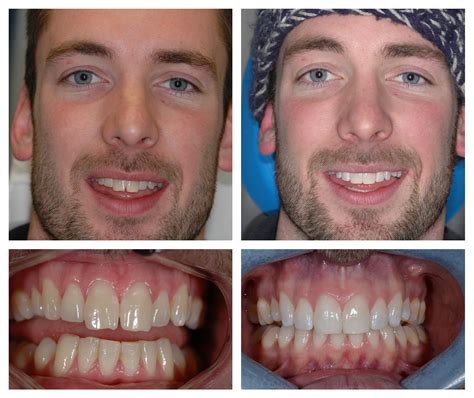 Surrey Lingual Braces Treatments for Rotated Teeth