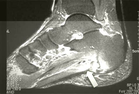 Radiographic Diagnosis (MRI) of Plantar Fasciitis - PT Master Guide