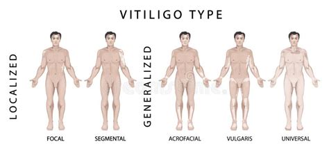 Types of Vitiligo. Medical Illustration Stock Vector - Illustration of ...