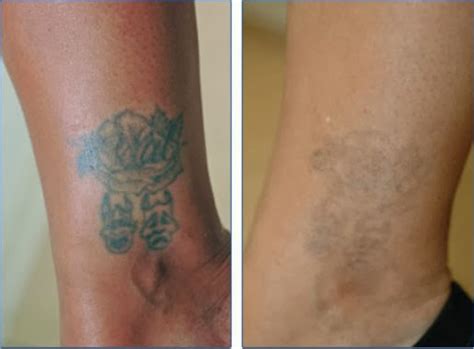 Natural Tattoo Removal: How To Remove Tattoos At Home - Dermabrasion