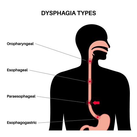 Understanding the Difference Between Odynophagia and Dysphagia ...