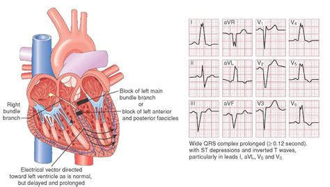 Diagnostic ECG—The 12-Lead (Clinical Essentials) (Paramedic Care) Part 4