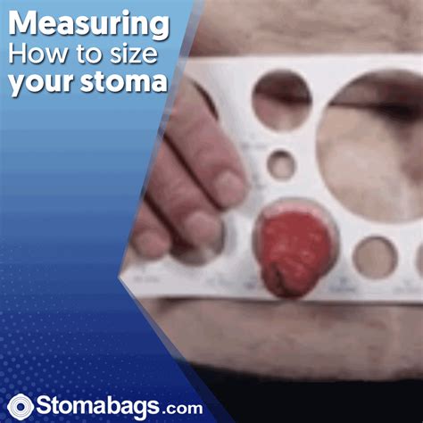 Measuring – How to size your stoma | Enfermagem