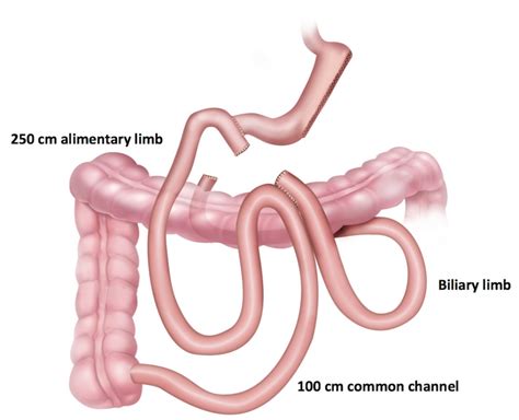 Duodenal Switch Surgery | Aloha Surgery | Weight Loss Surgery