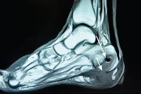 Mri Plantar Foot Anatomy Muscles