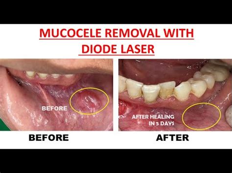 Mucocele removal with diode laser - Live Surgery - DR Rohan Virani ...