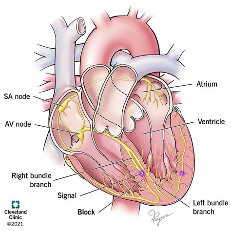 Right Bundle Branch Block: What Is It, Causes, Symptoms & Treatment