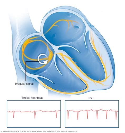 Supraventricular tachycardia - Symptoms and causes - Mayo Clinic