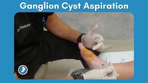 Ganglion Cyst Aspiration - YouTube