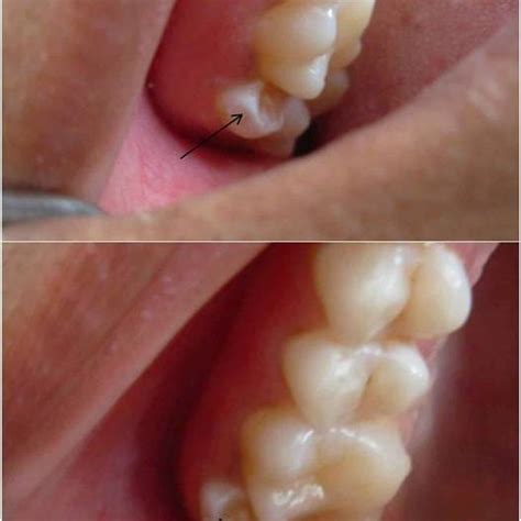 (PDF) Maxillary paramolar: Report of a case and literature review