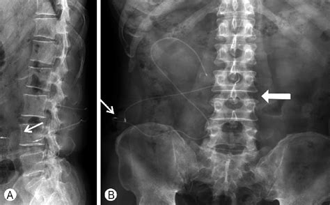 Lumboperitoneal shunt using the anterior superior iliac spine as the ...