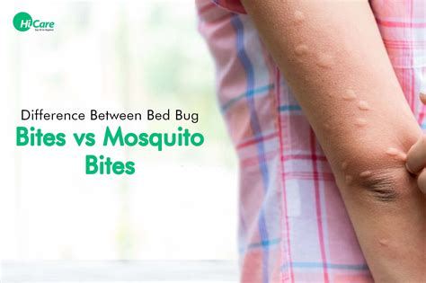 Mosquito Bites Vs Bed Bug Bites – NBKomputer