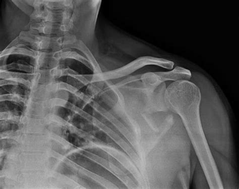 Scapula Fracture - Orthopedics - Medbullets Step 2/3