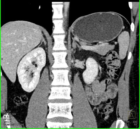 Adenoma Left Adrenal Gland - Adrenal Case Studies - CTisus CT Scanning