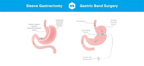 Gastric Sleeve or Lap Band Surgery - What is best for you?