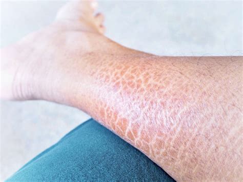 Ichthyosis: 10 Ichthyosis Symptoms