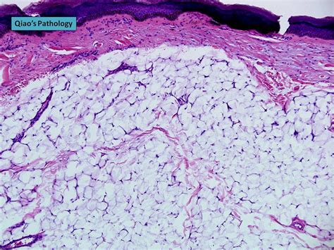 Qiao's Pathology: Nevus Lipomatosus Cutaneous Superficiali… | Flickr