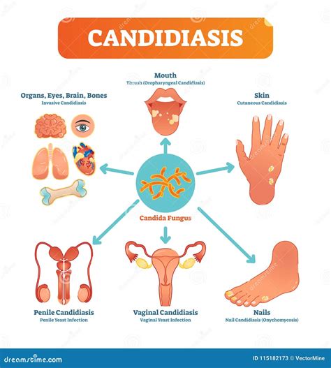 Candidiasis Medical Vector Illustration Diagram Poster with All Types ...