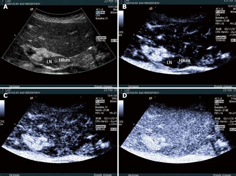 Lymphoma Lymph Nodes Ultrasound