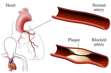 Coronary Heart Disease - Causes and Risk Factors | NHLBI, NIH