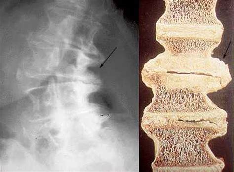 Radiological Degenerative Joint Disease (Osteoarthritis) of the Spine ...